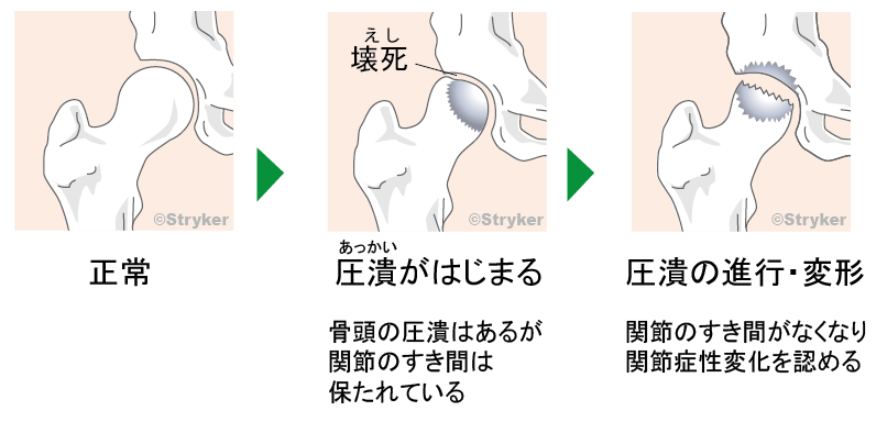 圧潰 なんて読む？