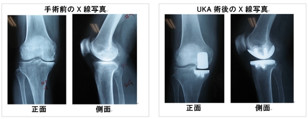 第18回 『人工膝単顆置換術＝UKAとは』｜関節の広場 -いつまでも、歩き